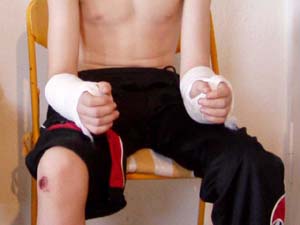 Mein Sohn hat sich beide Unterarne gebrochen.